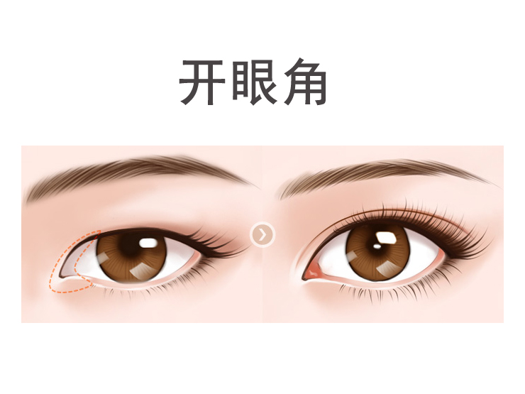 开眼角