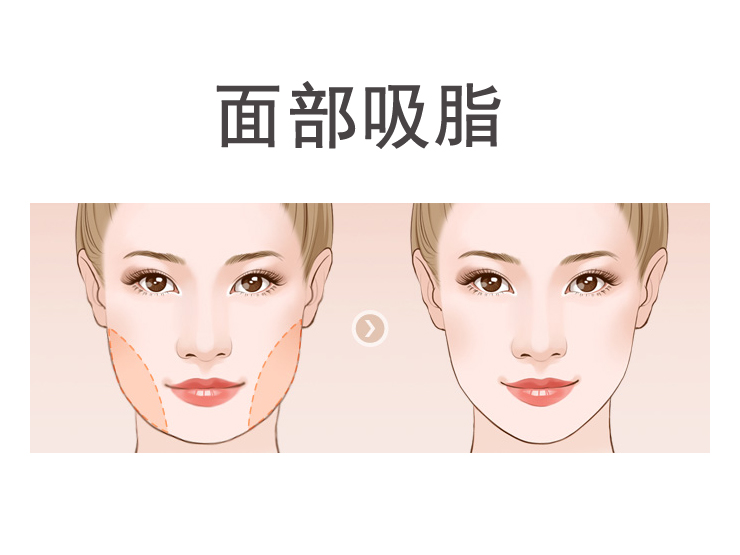 面部吸脂