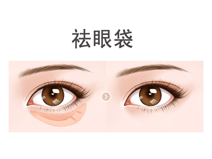 祛眼袋