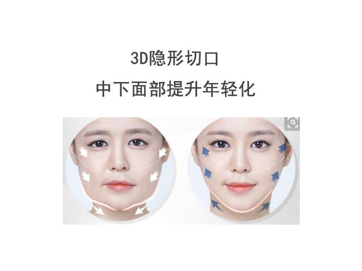 3D隐形切口中下面部提升年轻化