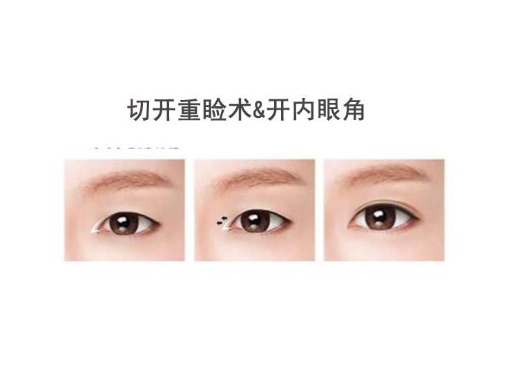 切开重睑术&开内眼角
