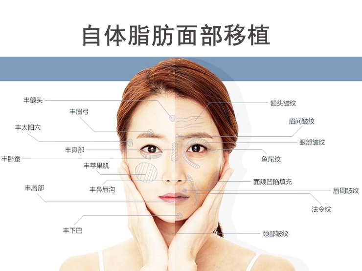 自体脂肪面部移植