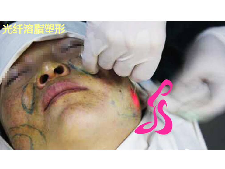 光纤溶脂塑形